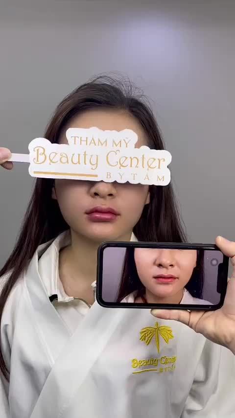 Tiêm filler cải thiện tình trạng môi lệch, má hóp, rãnh cười sâu cho bạn khách hàng xinh đẹp