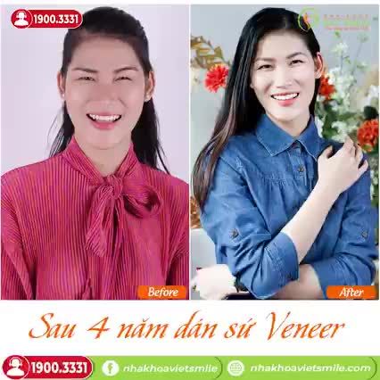 SAU 4 NĂM DÁN SỨ VENEER TẠI VIET SMILE