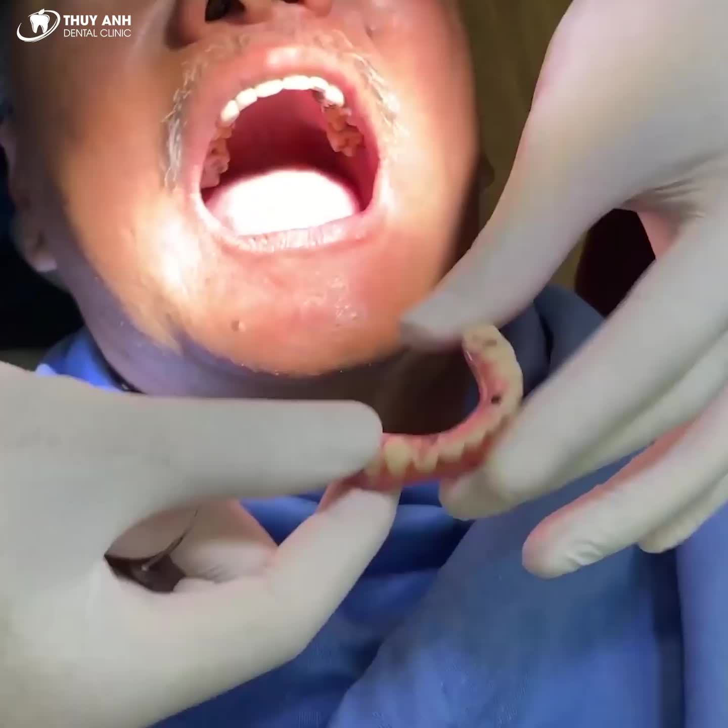 HƠN 1.000 CÔ CHÚ ĐÃ CÓ THỂ ĂN NGON - NHAI KHỎE CÙNG IMPLANT ALL ON 4