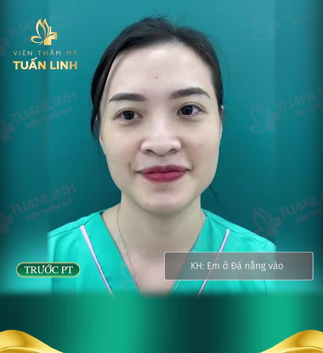 Nâng cấp chiếc mũi xinh cho cô gái đến từ Đà Nẵng