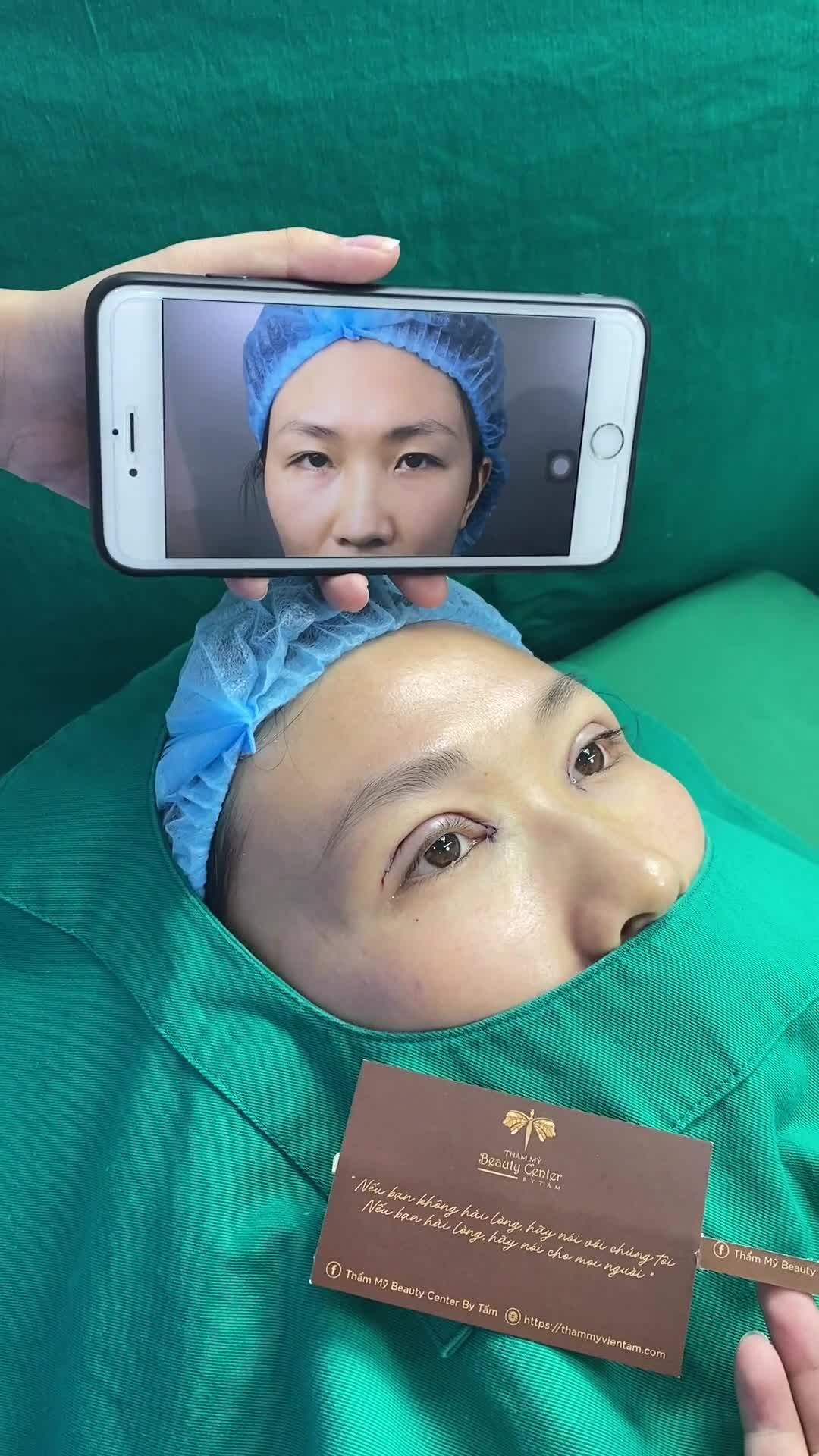 Ca Combo Cắt mí+mở góc trong cho khách hàng tại Hà Nội