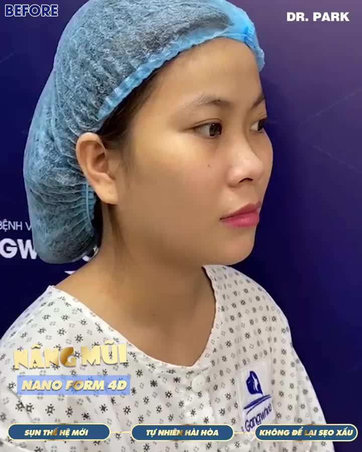 NÂNG MŨI CẤU TRÚC VÌ SAO ĐƯỢC GỌI LÀ NÂNG MŨI 3 TỐT