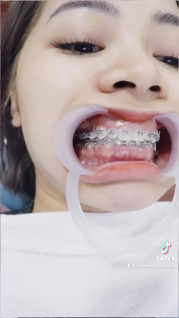 Chúc mừng Kim Tuyến chuẩn bị “cán đích trên hành trình niềng răng của mình.