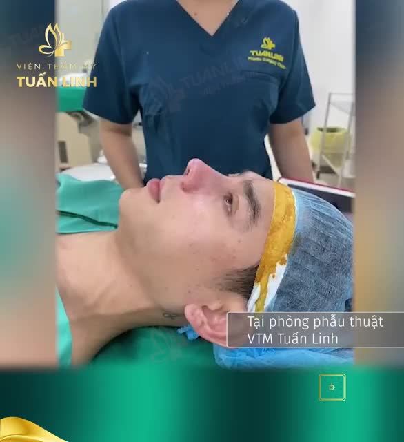 Khách hàng đến từ HUẾ thay đổi bất ngờ sau 120 phút sửa lại mũi tại Tuấn Linh !!!