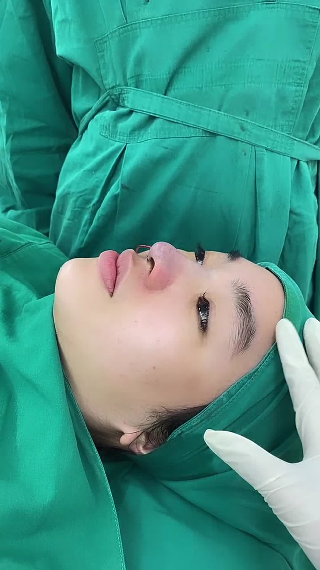 Chị khách đã nâng trước đó nhưng chưa hài lòng, mũi bị lệch.