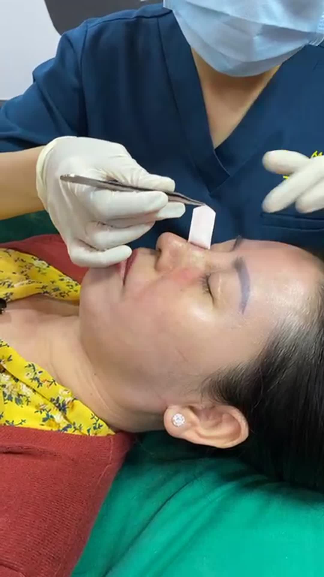 Ca mũi cấu trúc surgiform được 10 ngày tại Viện