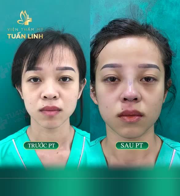 DÁNG MŨI CẤU TRÚC SAU 10 NGÀY TÁI KHÁM