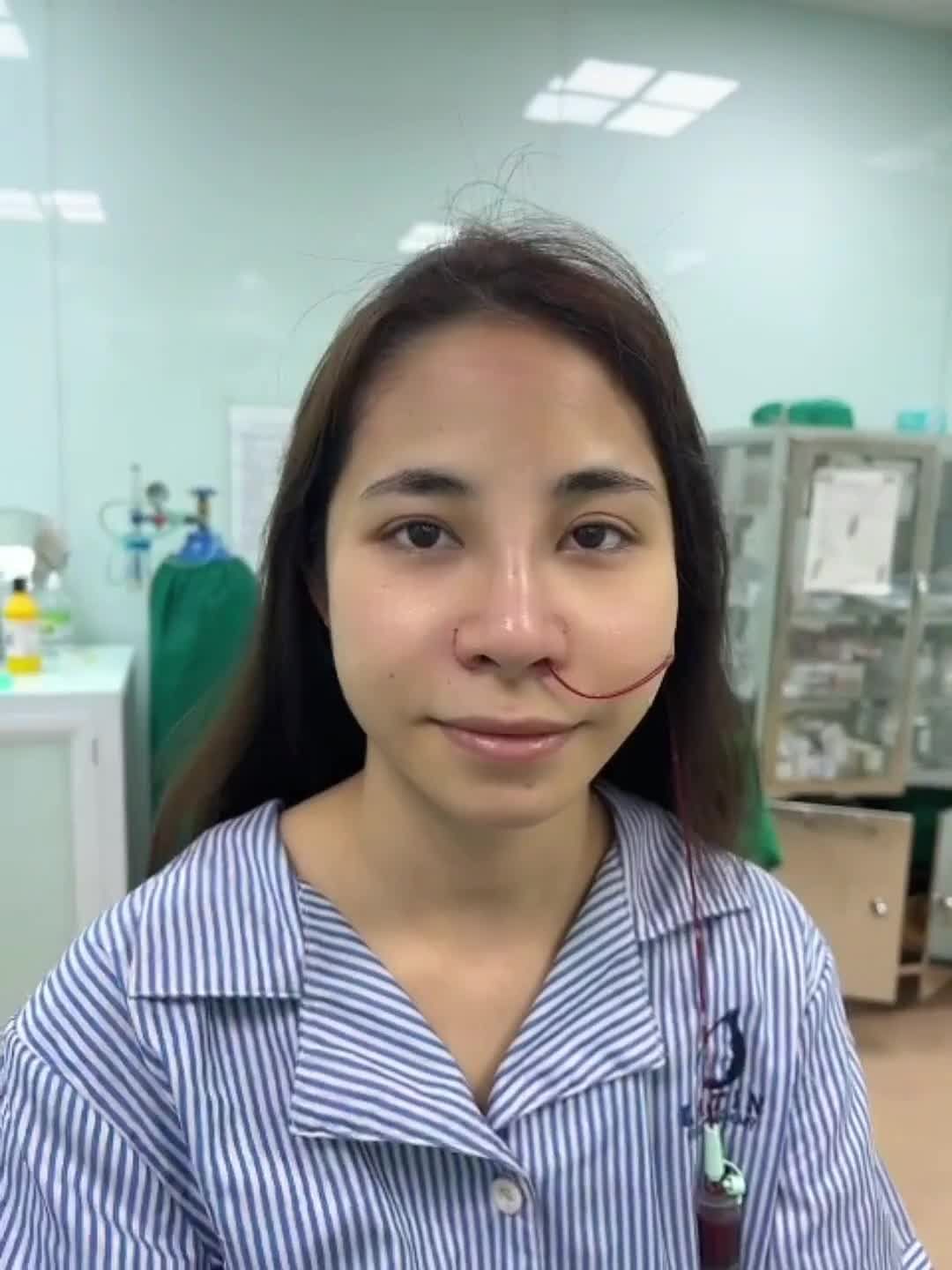 Giải pháp nào cho mũi từng tiêm Filler