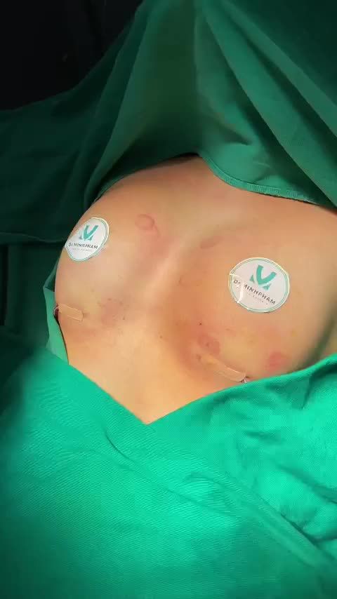 Kết Quả Ca Nâng Ngực Được Thực Hiện Bởi Ekip Dr. Minh Phạm
