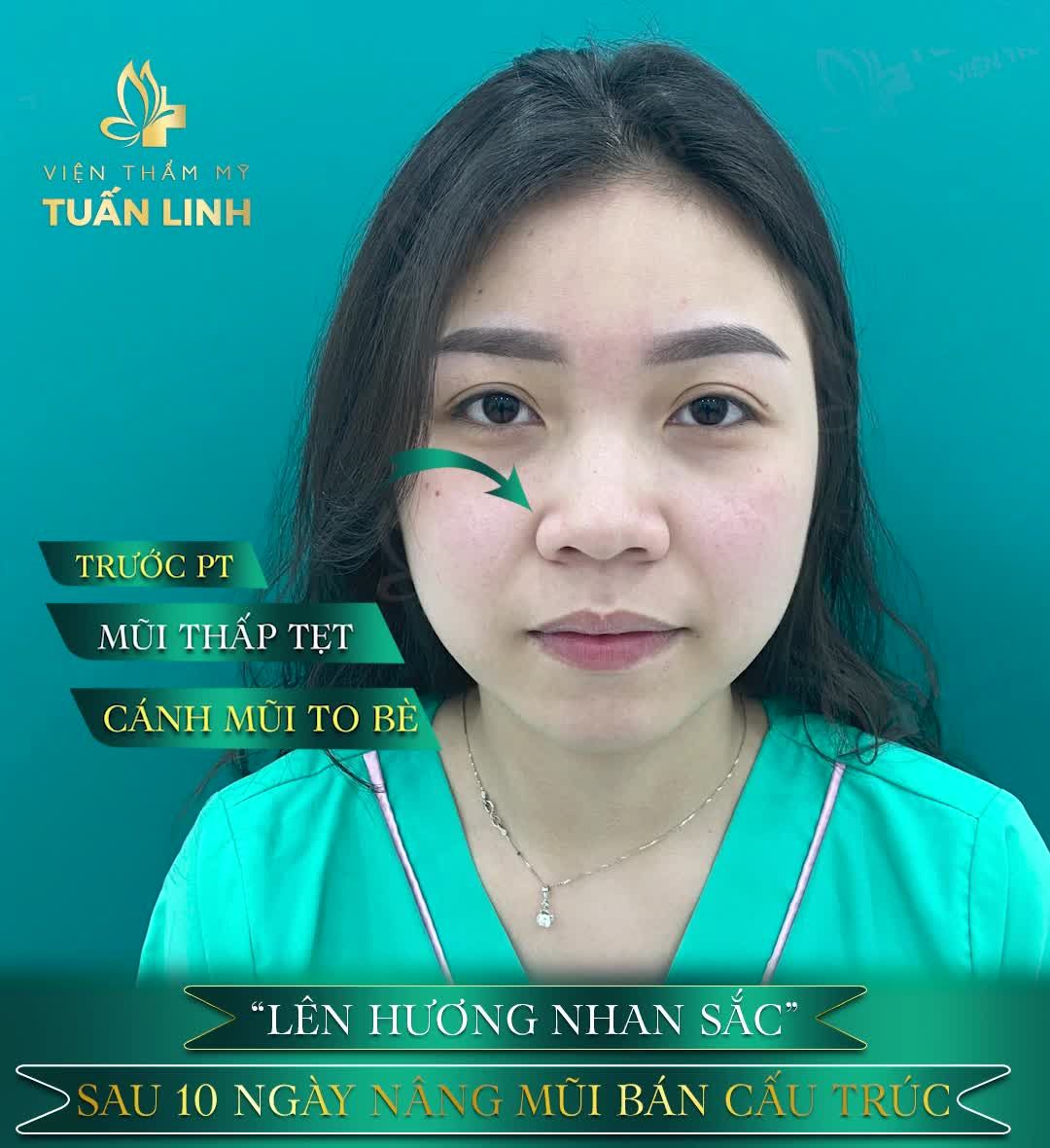 Một chiếc mũi cao sang sẽ giúp thay đổi diện mạo của một cô gái như thế nào