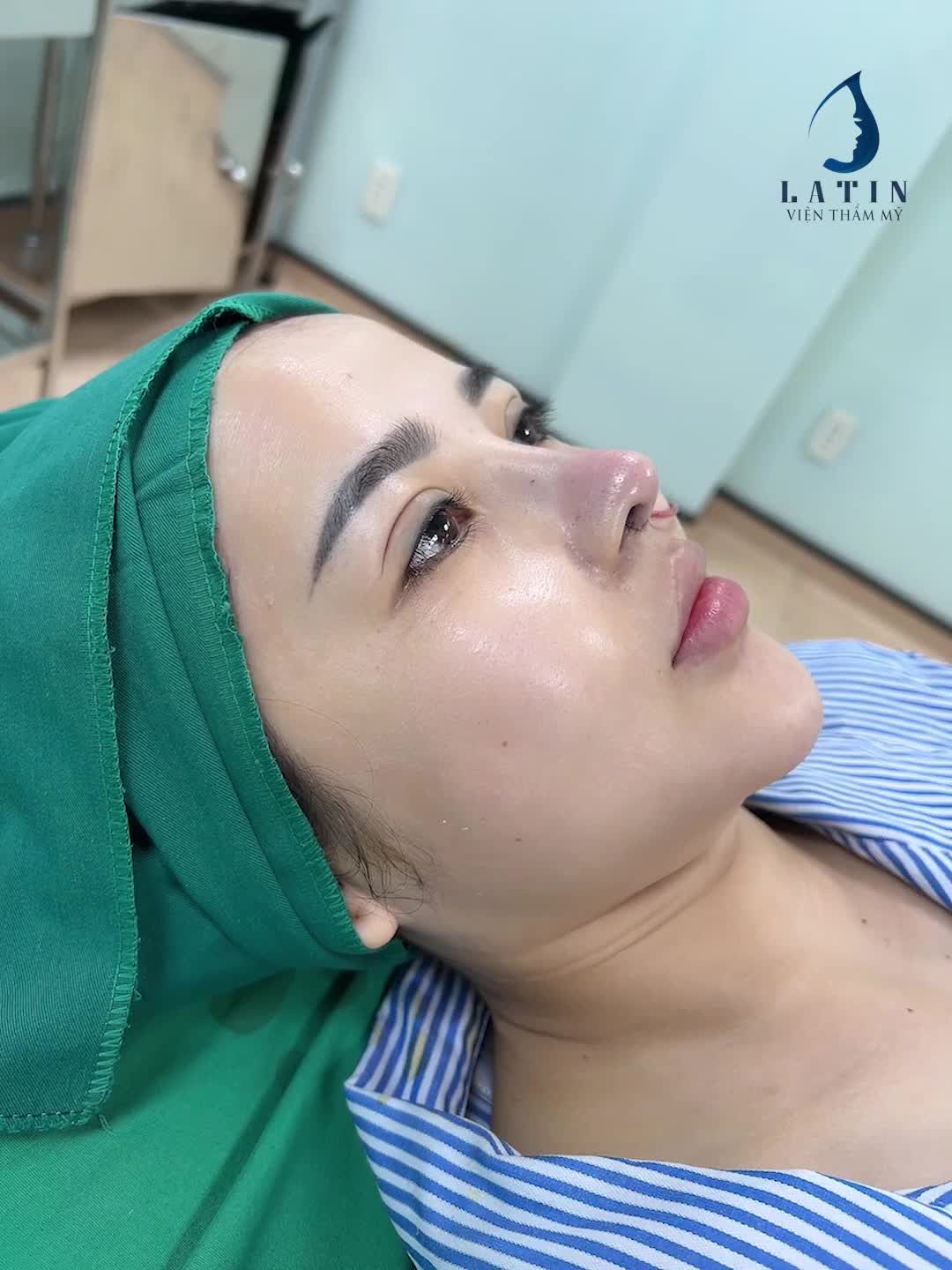 Mũi nâng cấu trúc rồi sửa lại sẽ ra sao