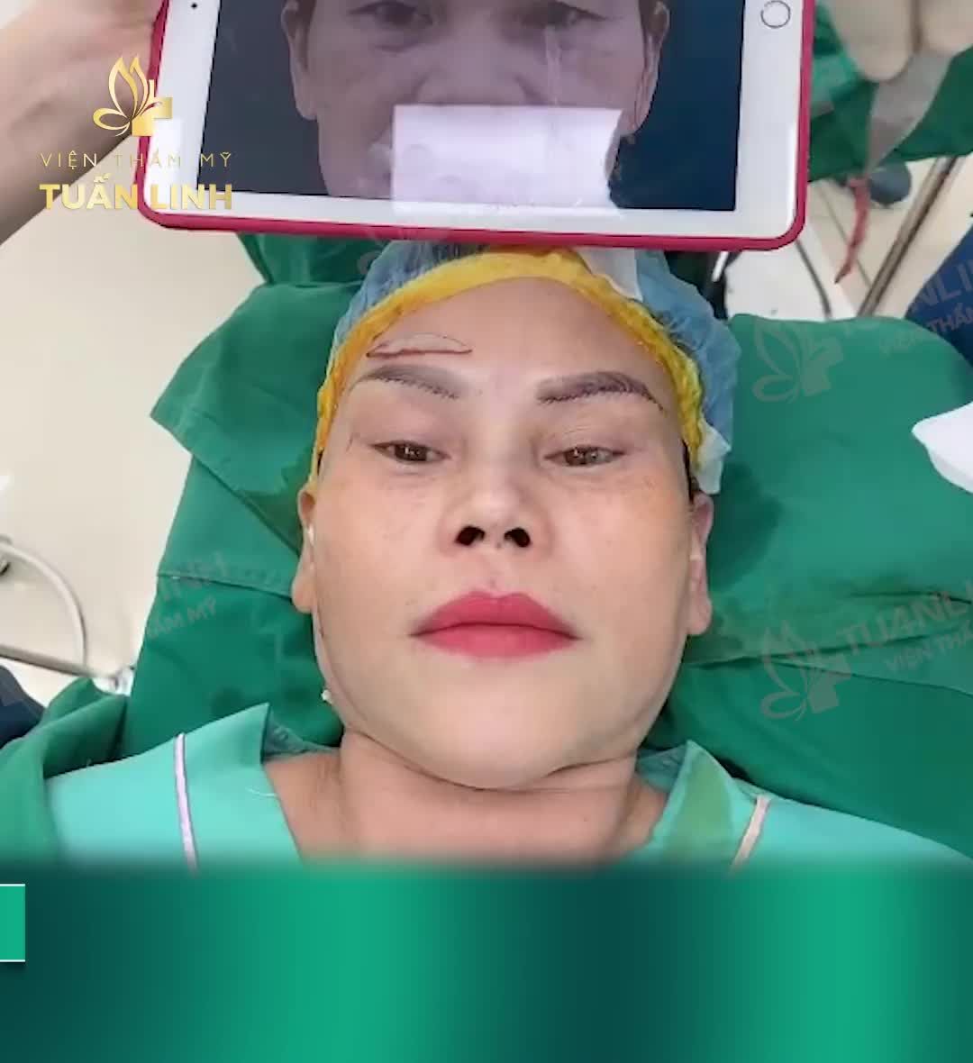 Lấy lại thanh xuân cho bác gái 55 tuổi với combo nâng mũi bọc sụn, nâng cung chân mày