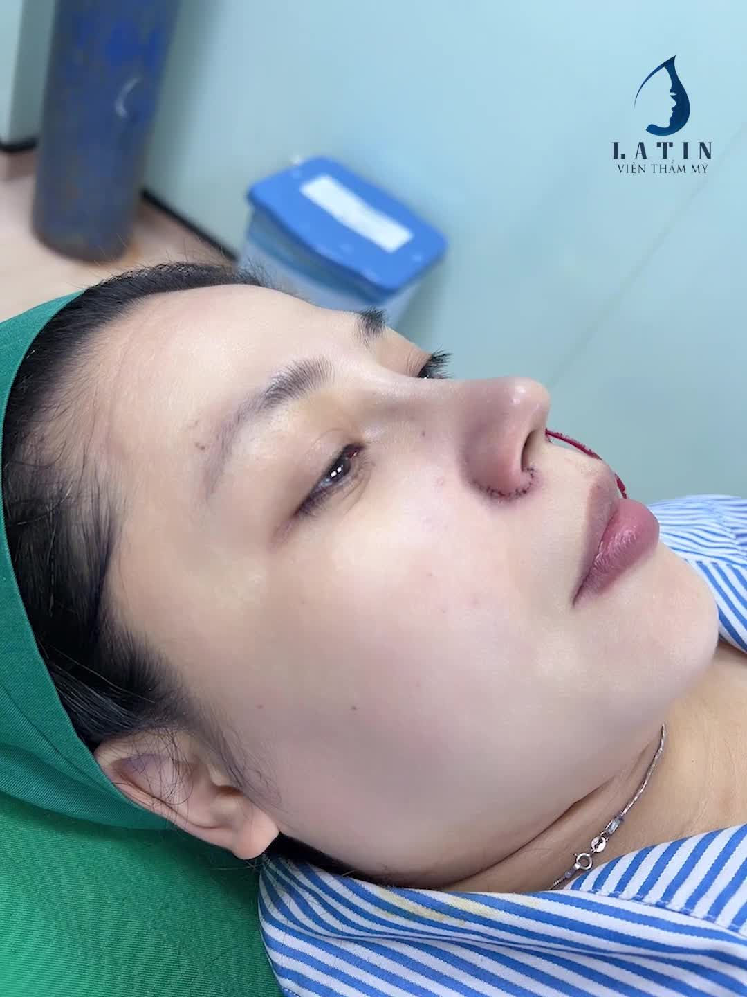 Mũi bán cấu trúc và cuộn cánh cho KH từ Nha Trang