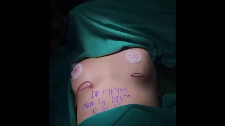 Ca Nâng Ngực Vừa Được Thực Hiện Bởi Ekip Dr. Minh Phạm