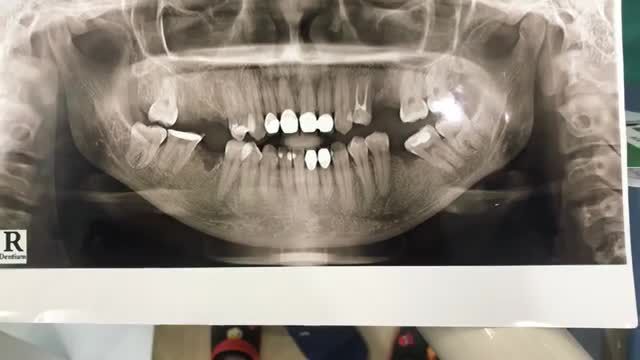 Ca cấy ghép chân răng nhân tạo Implant cho khách hàng mất răng số 36.