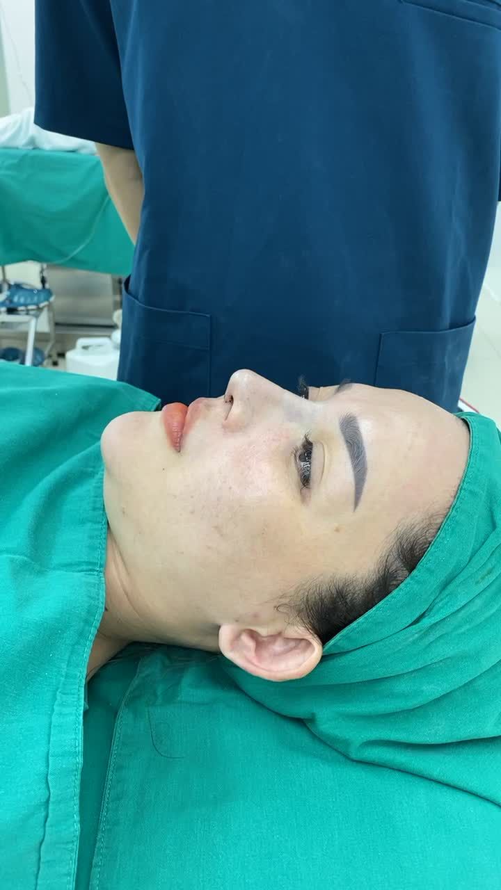 Case nâng mũi cấu trúc sụn Surgiform sau 90 phút phẫu thuật cho cô gái đến từ SÓC TRĂNG.