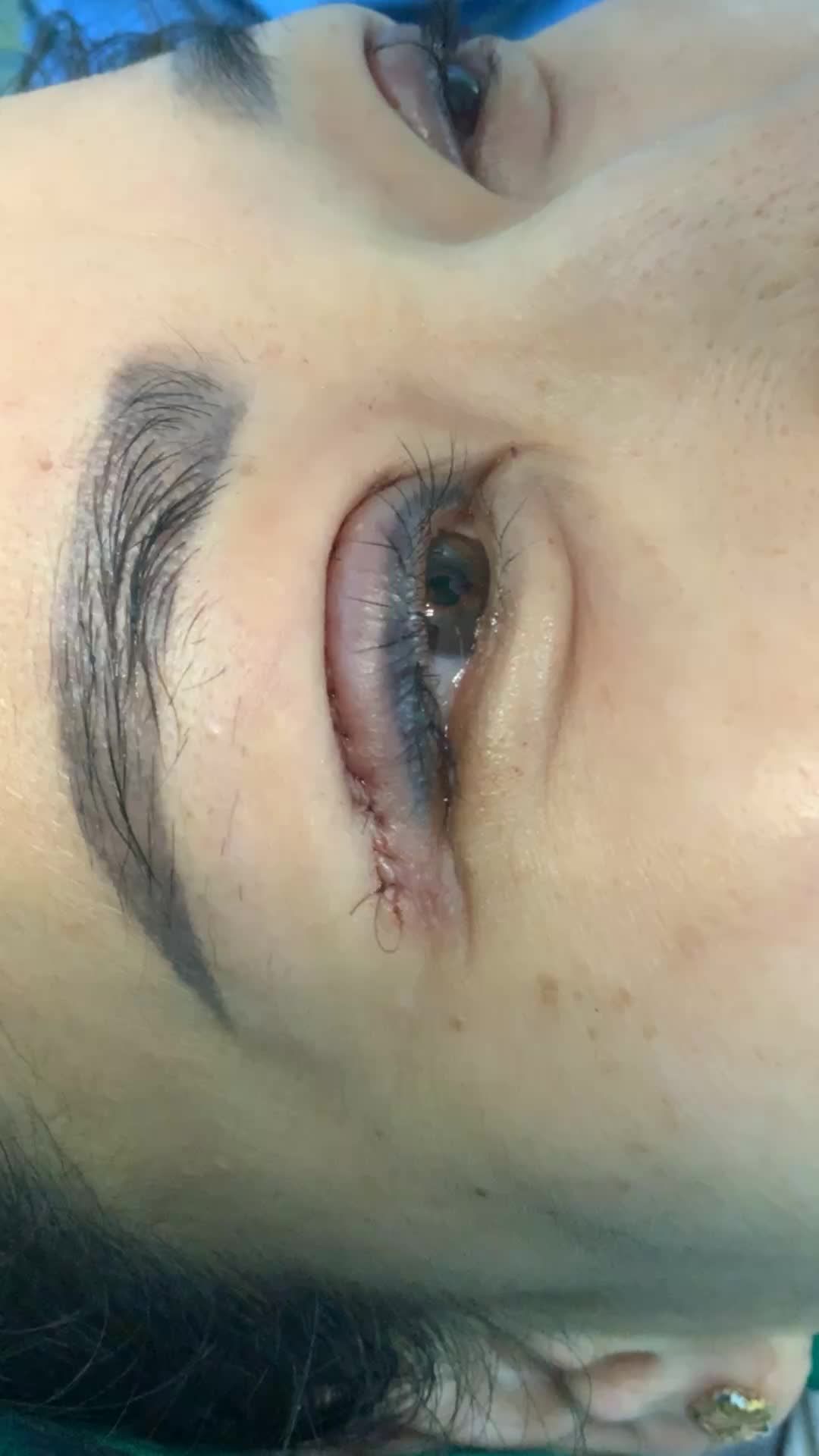 Kết thúc ngày làm việc cuối tuần ở HN của Dr Vương là ca mí trên, tháo chỉ nhấn mí cũ