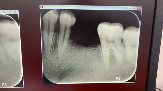Lắp răng Implant phục hồi lại răng 36 bị mất cho anh khách hàng.