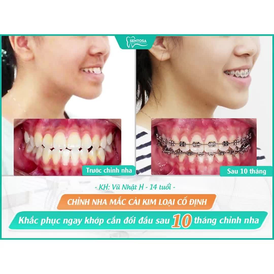 CHỌN NƠI NIỀNG RĂNG, NHẤT ĐỊNH BẠN PHẢI BIẾT ĐIỀU NÀY