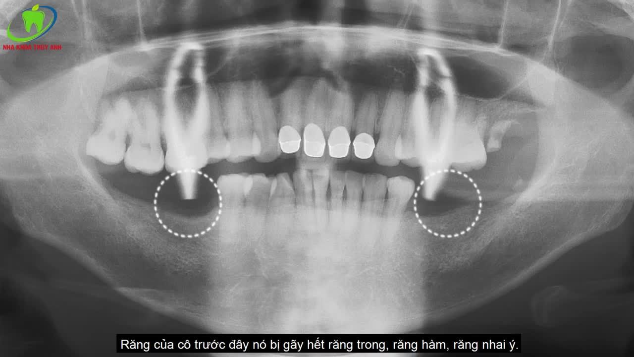 CẢM NHẬN SAU 4 THÁNG TRỒNG RĂNG IMPLANT