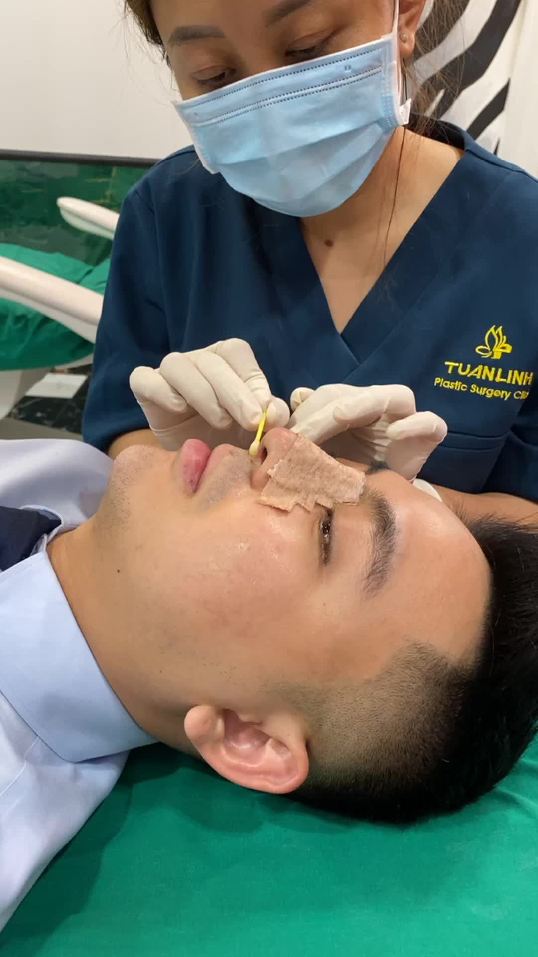 Case nâng mũi cấu trúc bóc tách chỉ tháo nẹp, tái khám sau 10 ngày.