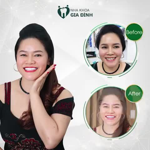 CÔNG CUỘC THAY ĐỔI NỤ CƯỜI ĐẦY NGOẠN MỤC CỦA KHÁCH HÀNG TẠI NHA KHOA GIA ĐÌNH
