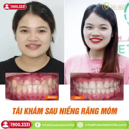 TÁI KHÁM SAU 6 THÁNG THÁO NIỀNG MÓM