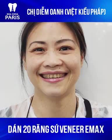 U40 - U50 răng Nhiễm Màu nhất định phải xem!!