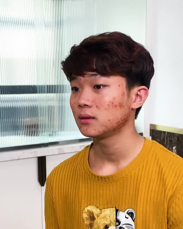 XỬ LÝ CA MỤN NẶNG CHO NAM SINH BỊ MỤN 5 NĂM KHÔNG DỨT