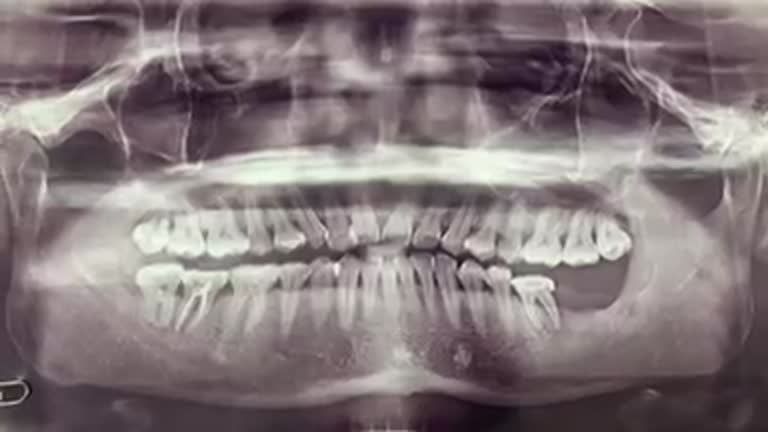 Quá trình trồng chân răng nhân tạo implant phục hình lại răng 37 bị mất.