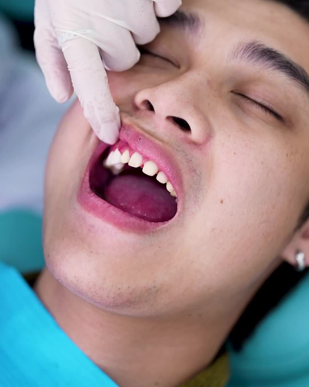 CẬN CẢNH QUY TRÌNH LẮP RĂNG SỨ ZIRCONIA TẠI NHA KHOA THU CÚC