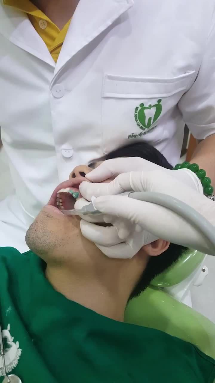 GẮN CỐ ĐỊNH VENEER SỨ CAO CẤP CHO MỘT NAM KHÁCH HÀNG