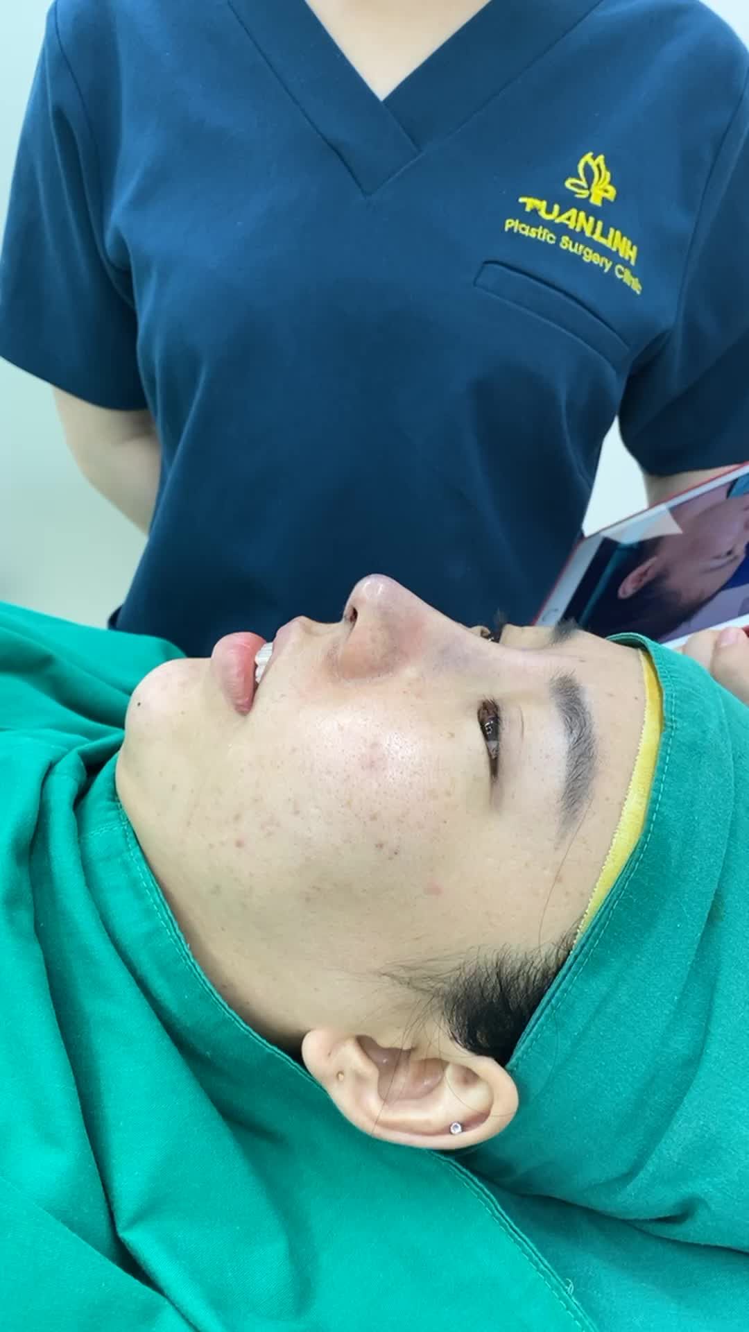 Nâng mũi Hàn Quốc sau 5 năm bị biến chứng...sửa lại và cái kết.
