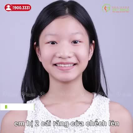 NIỀNG RĂNG TRẺ EM SAU 1 NĂM - CẢI THIỆN KHỚP CẮN