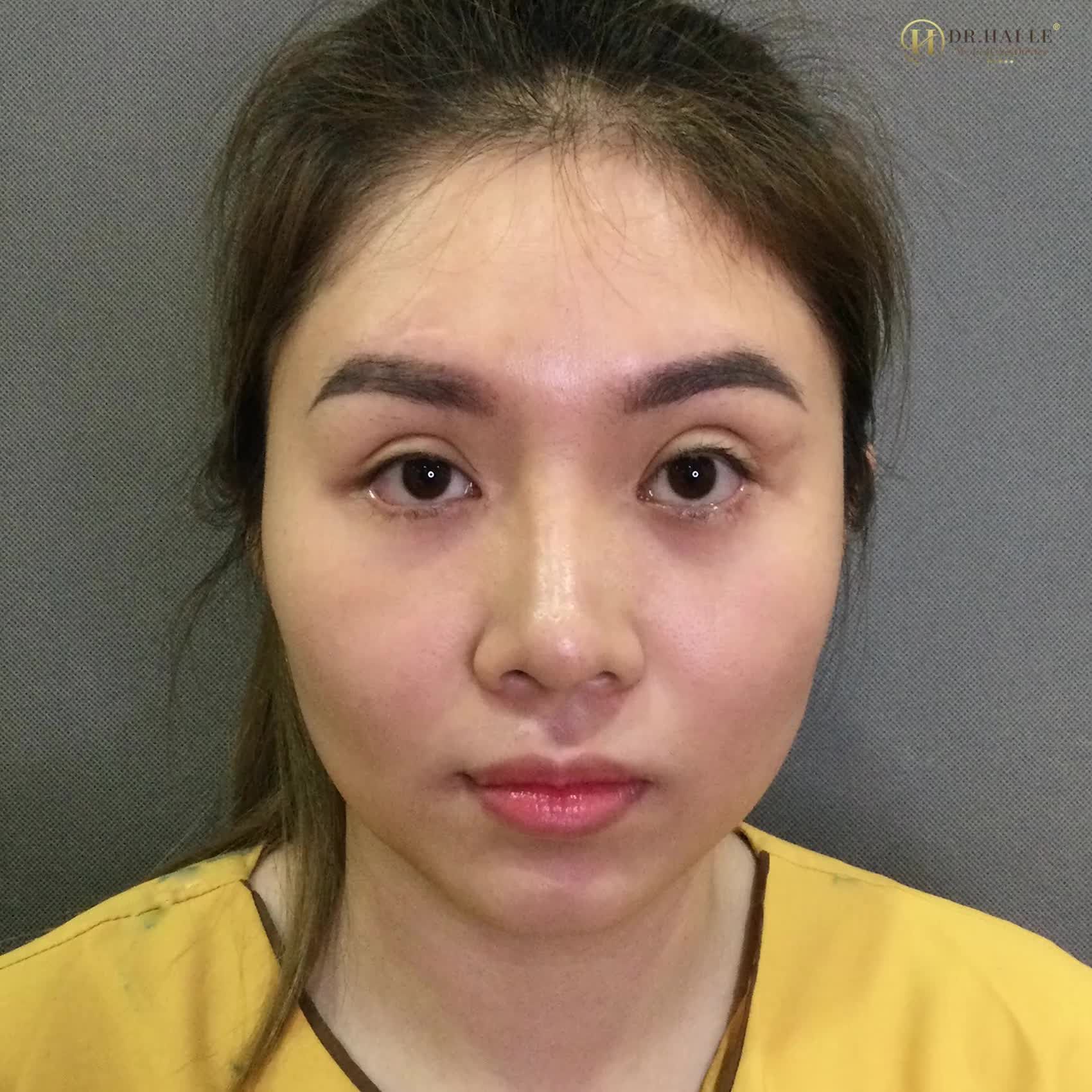 Tâm lí chung của hầu hết khách hàng trước khi tới Dr.Hải Lê sửa mí là Hoang mang, lo lắng, stress, trầm cảm, bế tắc.....