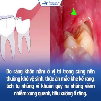 “BỎ TÚI” CÁCH XỬ LÝ RĂNG KHÔN AN TOÀN, KHÔNG ĐAU