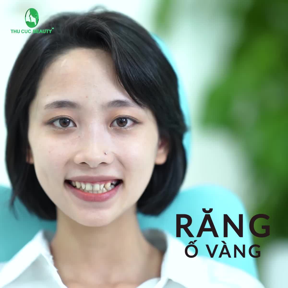 Để SĐT nhận ƯU ĐÃI SIÊU SỐC bọc răng sứ Zirconia