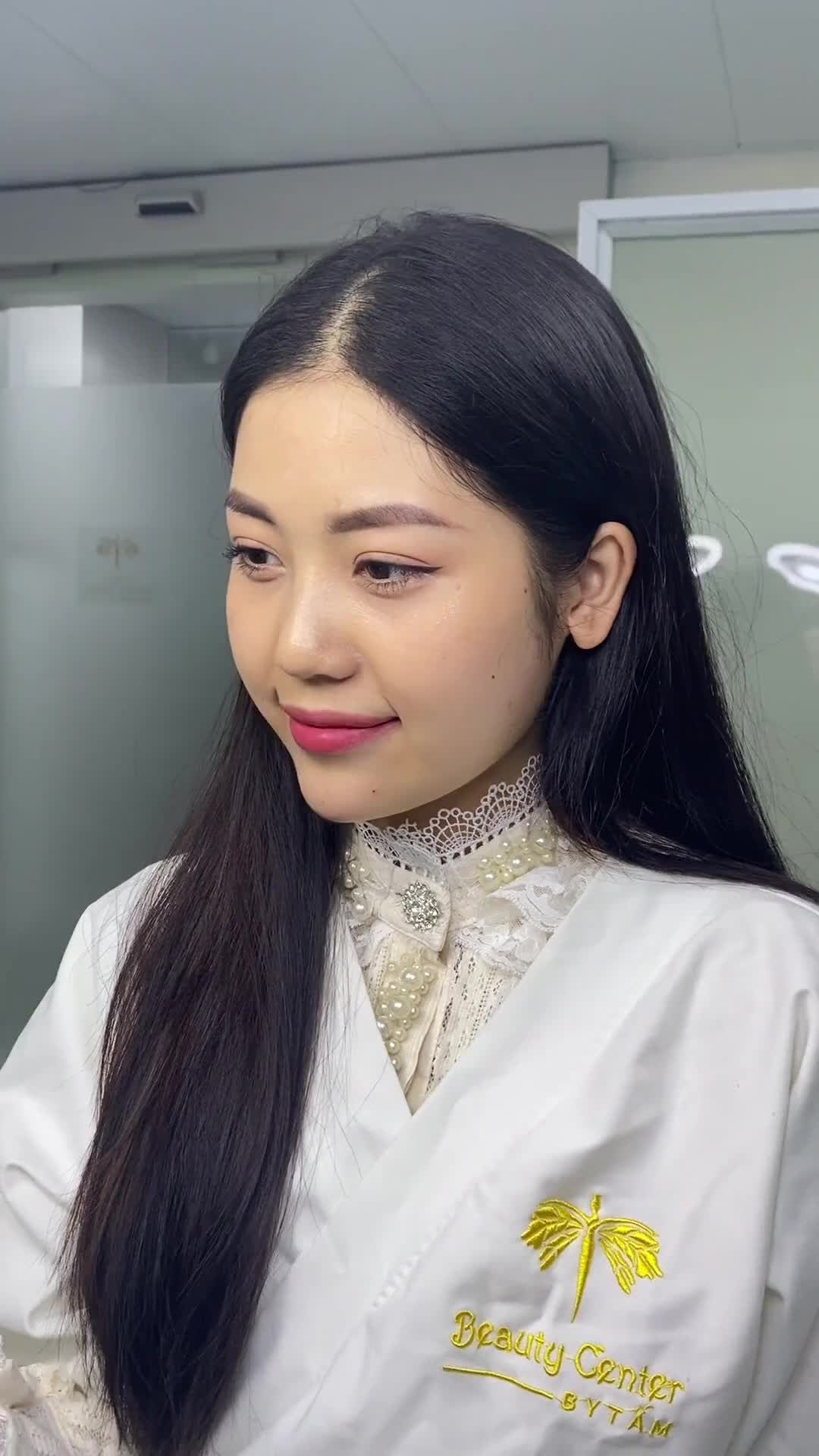 Kết quả hoàn hảo của bạn khách hàng sau 15 phút thực hiện filler má tại Tấm