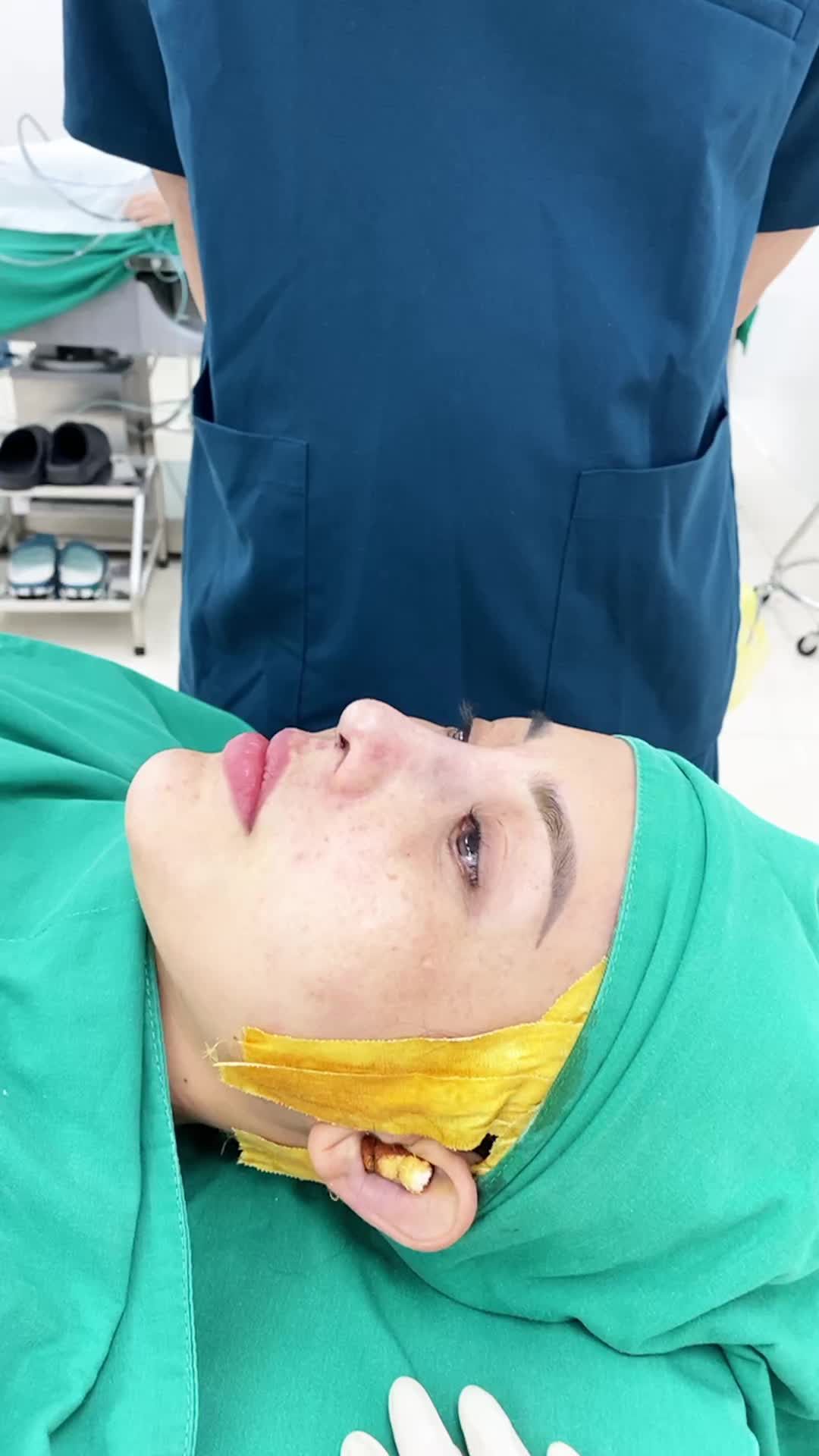 Nâng mũi sửa lại cho cô gái đến từ Tây Ninh...! Case nâng mũi thứ 8 trong ngày.
