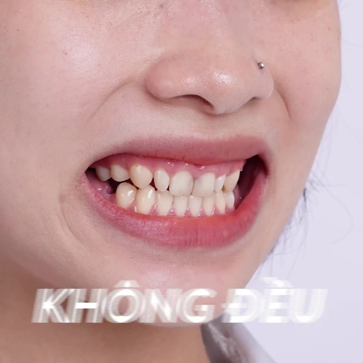 Tạm biệt răng sâu, ố vàng nhanh chóng - an toàn cùng bọc răng sứ Zirconia