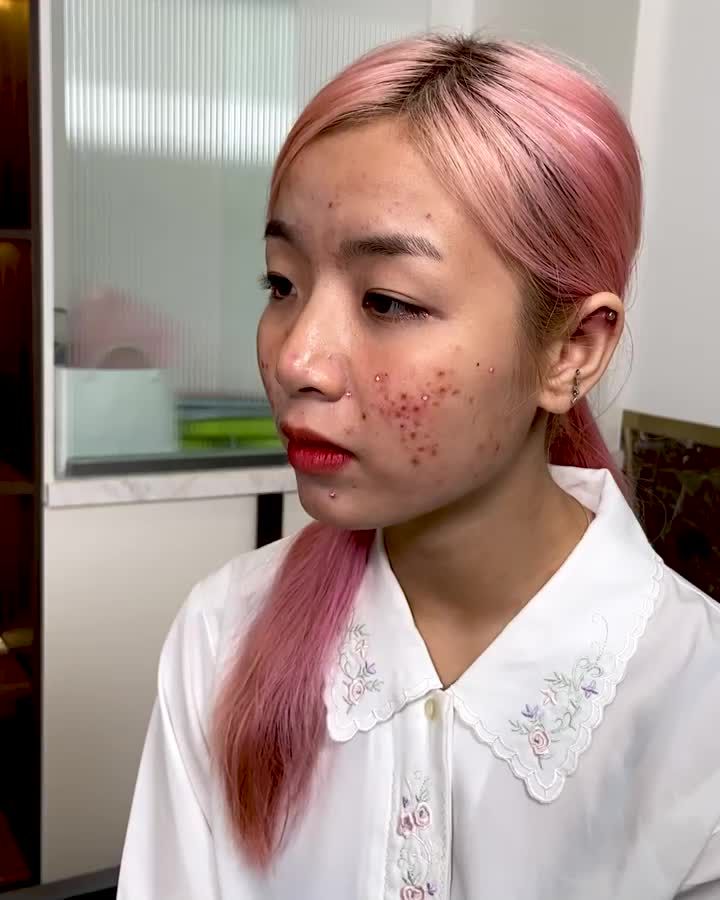 TẠI HỒNG NGỌC LIÊN TIẾP  ĐÓN NHẬN CÁC CA MỤN VIÊM SƯNG DO CHĂM SÓC SAI CÁCH