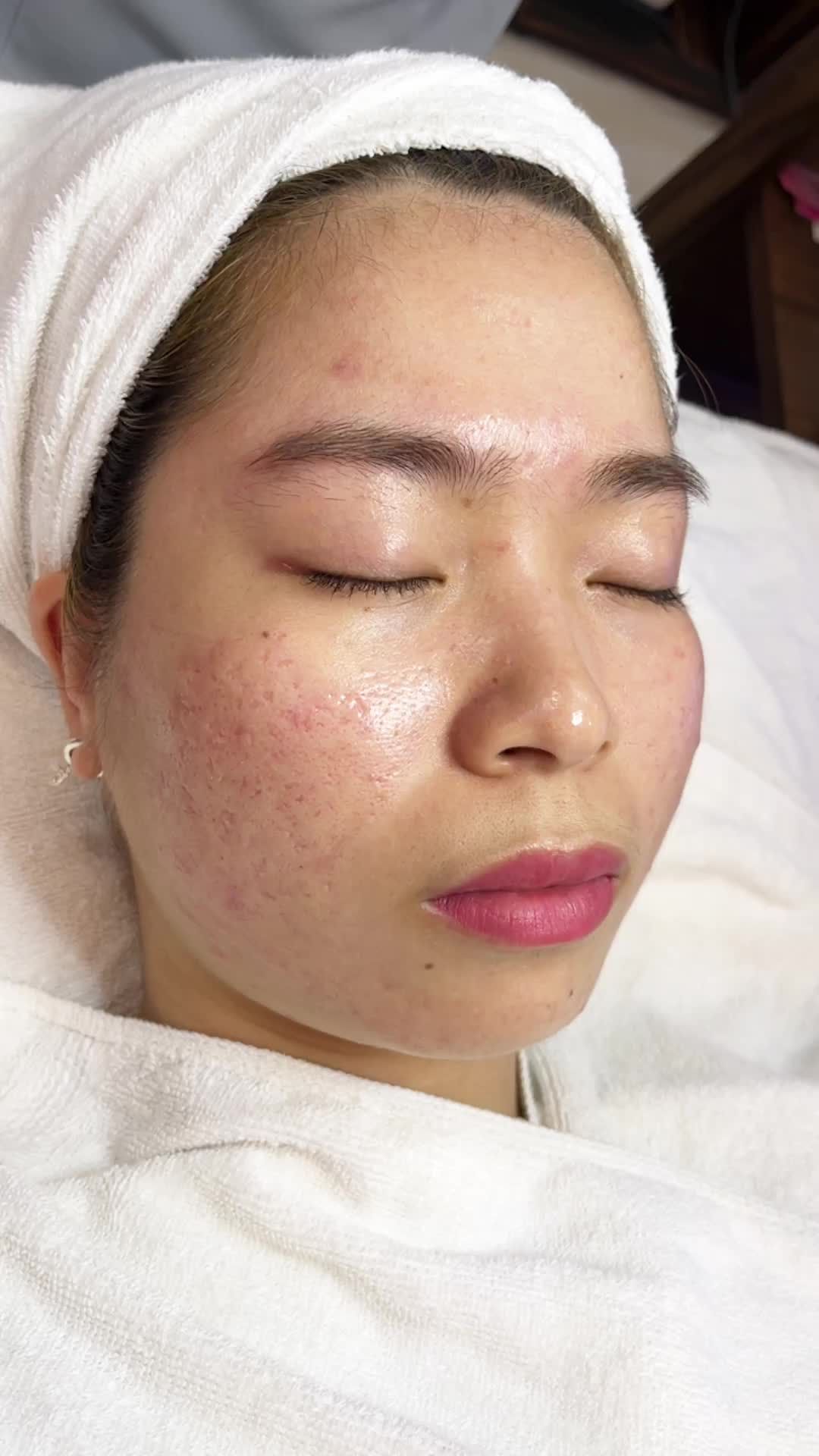 GIẢI CỨU DA MỤN THÂM LÂU NĂM – Cùng công nghệ De-acne tại BVTM Kangnam Hà Nội
