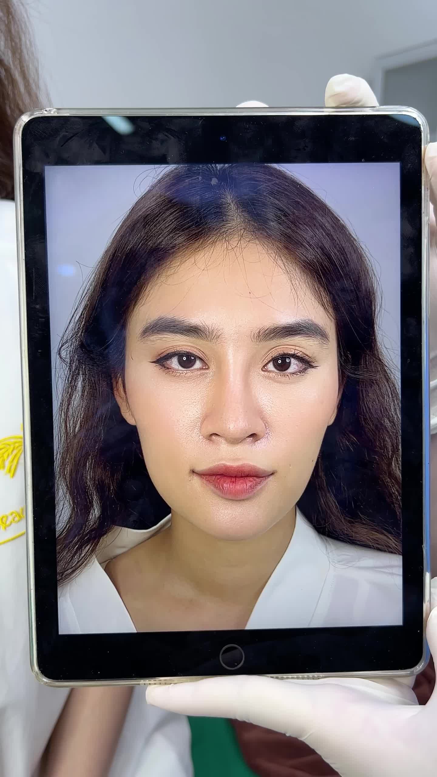 Bạn khách hàng sau khi tiêm FILLER MÁ BABY tại Tấm, tình trạng gò má cao, hai bên má không đồng đều đã được khắc phục. Cùng Tấm theo dõi kết quả bên dưới nhé.