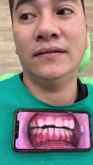 BS.CKI VŨ BÍCH DIỆP PHÂN TÍCH TÌNH TRẠNG RĂNG KHÁCH HÀNG
