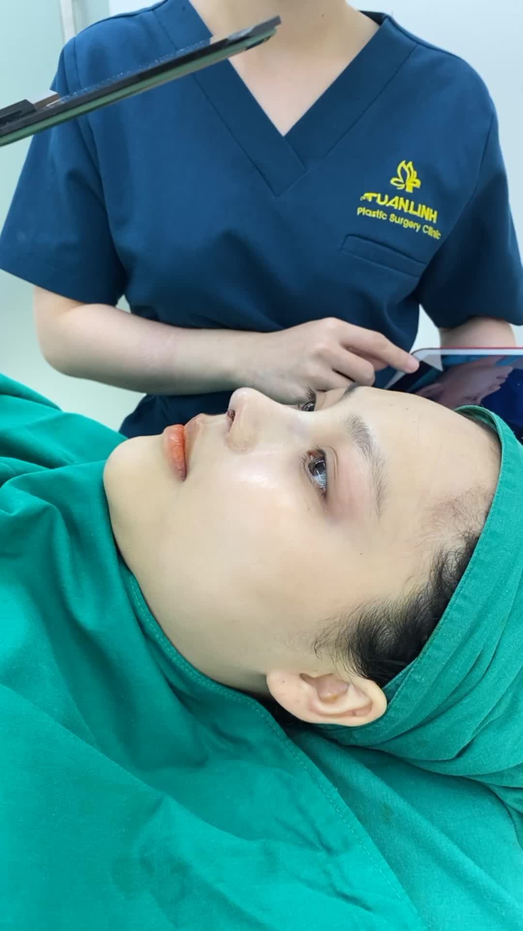 Case nâng mũi cấu trúc sửa lại Surgiform sau 90 phút phẫu thuật.