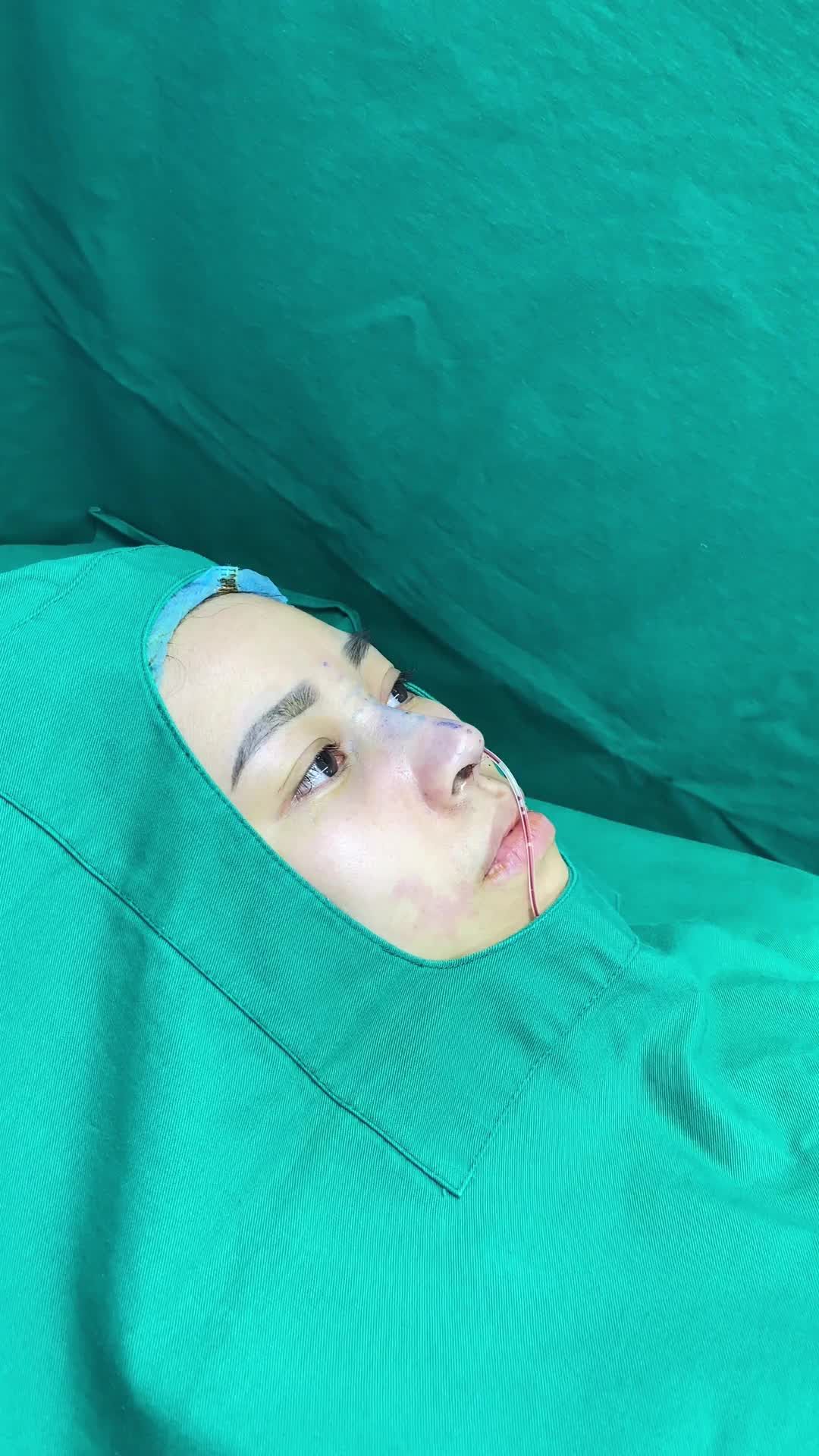 Ca nâng mũi Surgiform kết hợp mài gồ và bọc đầu mũi Megaderm