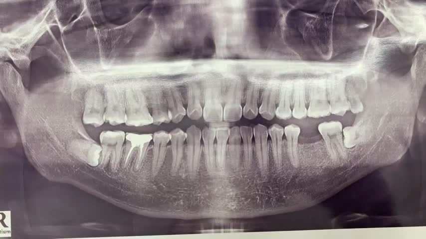 cấy chân răng nhân tạo implant phục hình răng 36 bị mất
