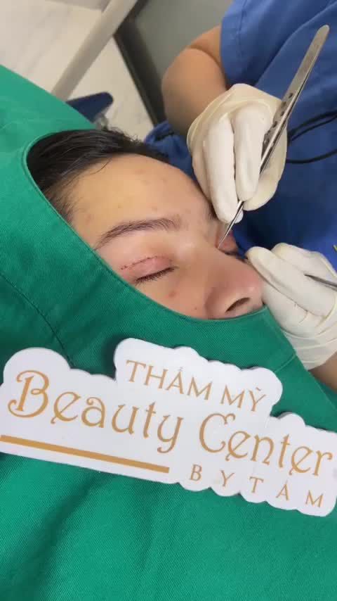 Bạn khách qua tái khám và cắt chỉ sau 7 ngày cắt mí Line Mini.