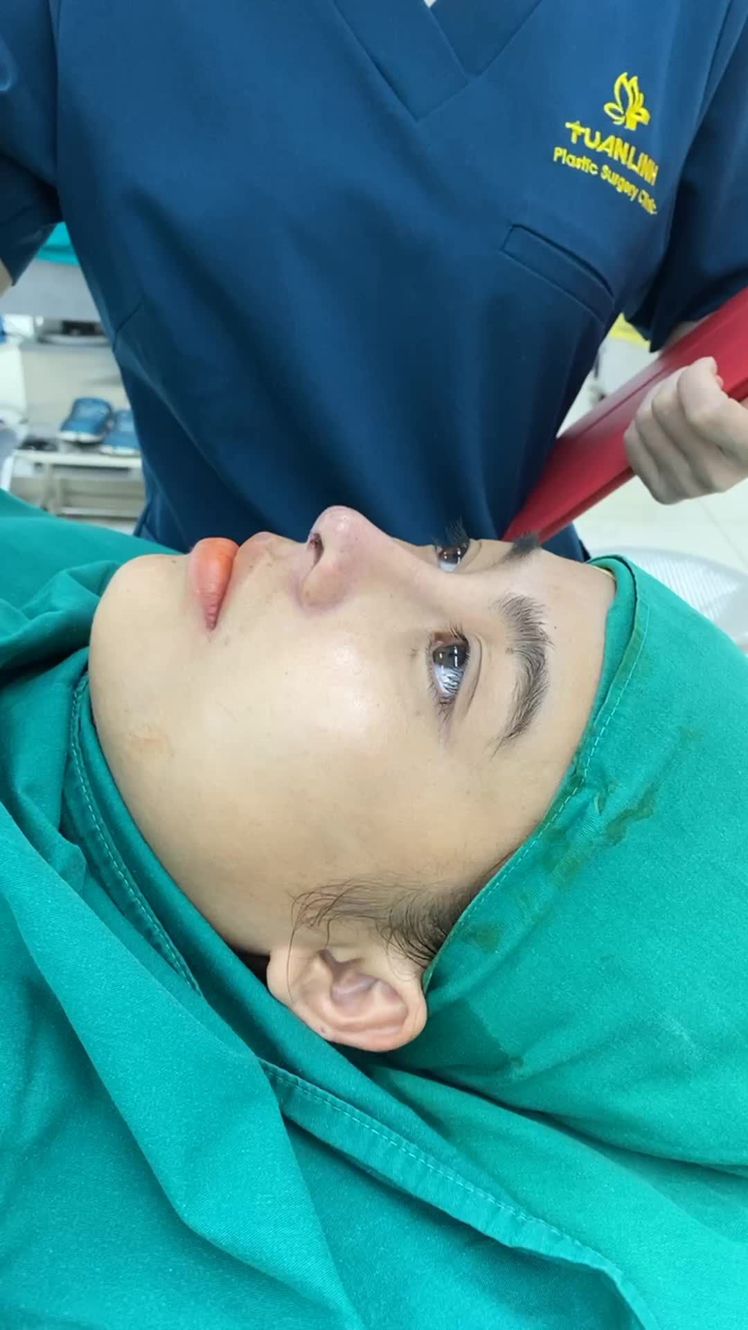 Case nâng mũi cấu trúc sửa lại sử dụng sụn Surgiform.