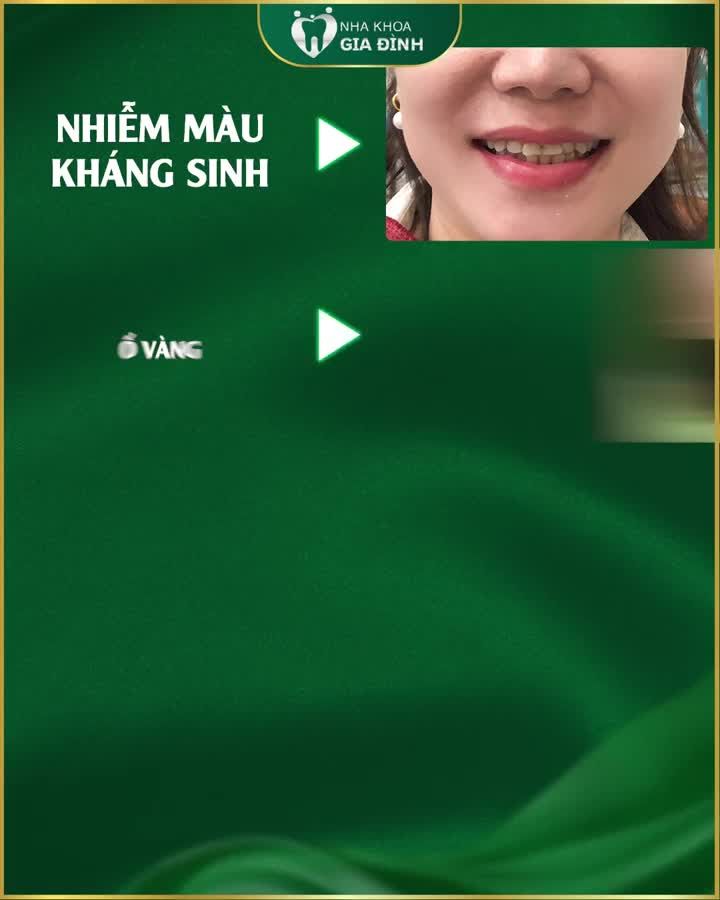 DÁN SỨ VENEER ĐƯỜNG CƯỜI TƯƠI VUI - BỪNG SÁNG DIỆN MẠO